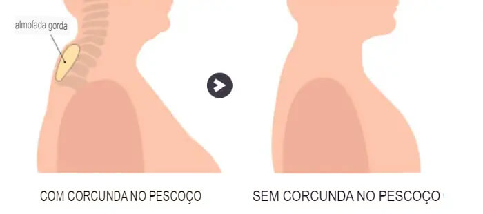 Almofada e Massageador com Sistema de Drenagem Linfática Ovelgo EMS